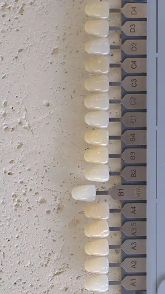 Choosing a tooth shade during cosmetic planning at Gentle Dentistry of Poway