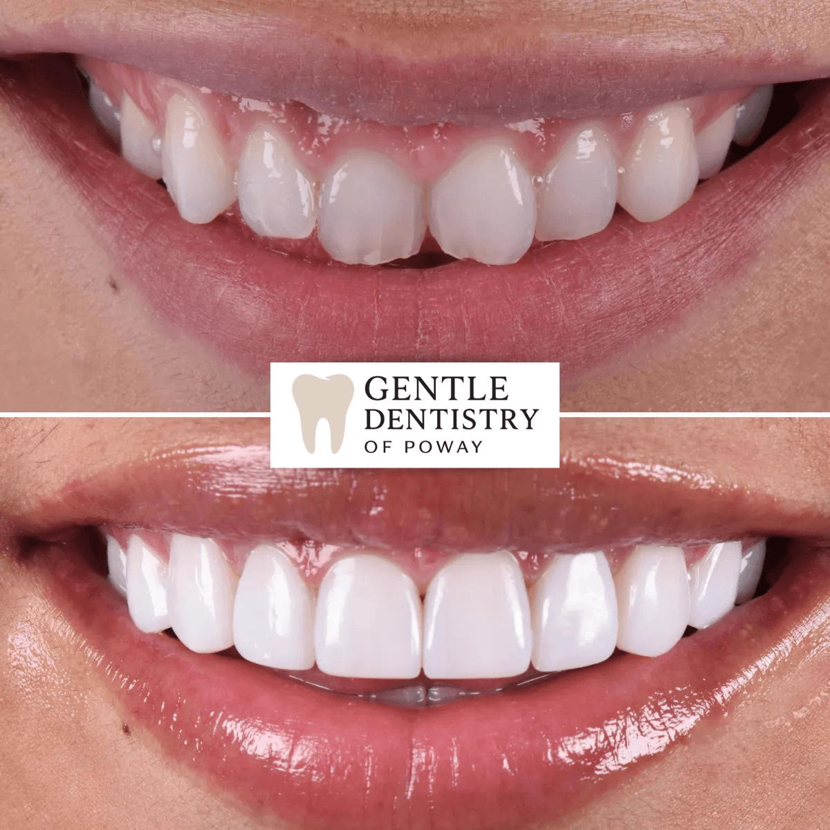 Invisalign before and after, patient treated at Gentle Dentistry of Poway