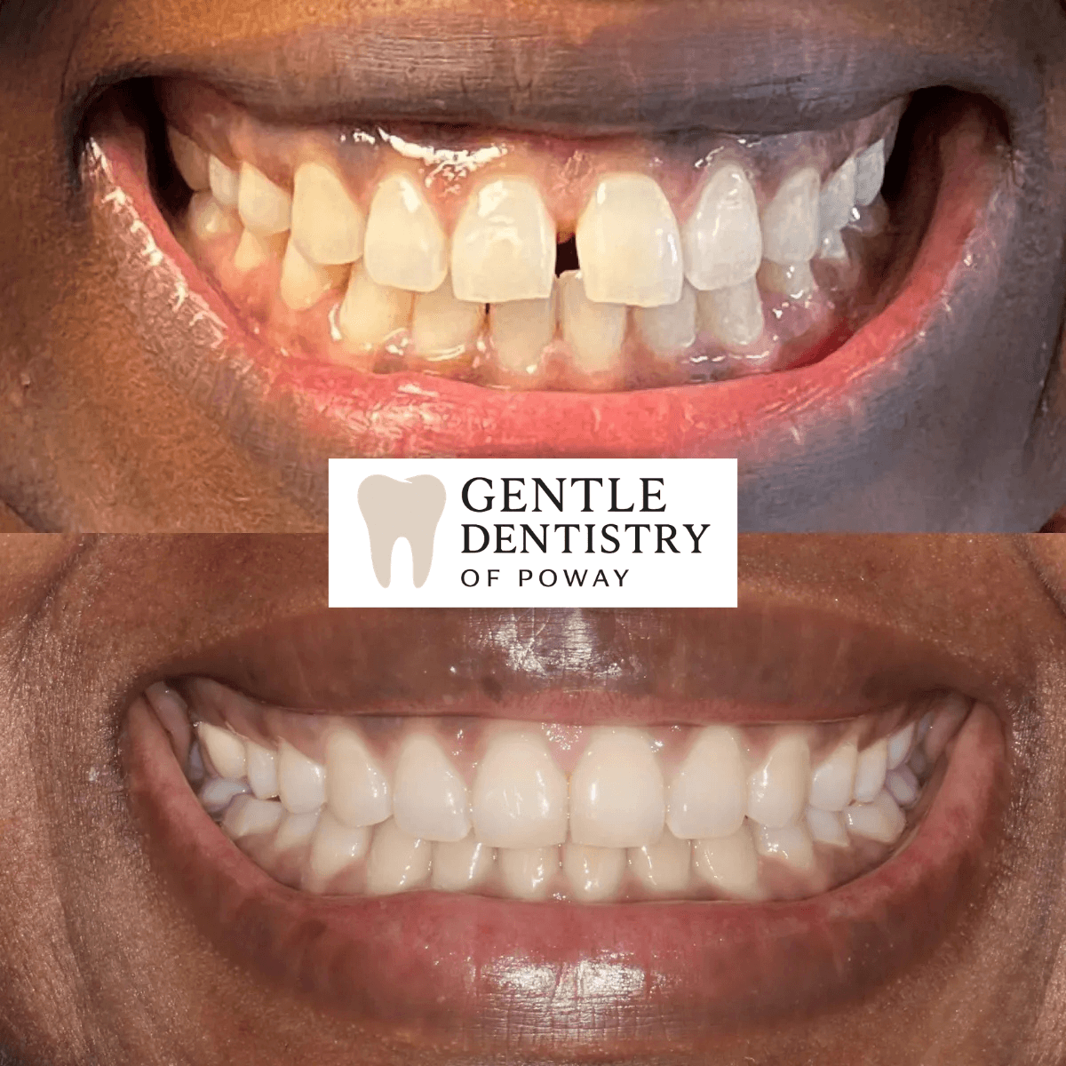 Smile alignment before and after at our Poway dental office